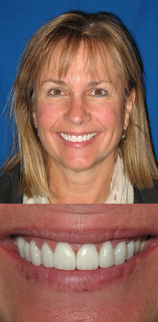 female patient's smile before and after treatment