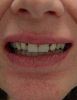 close-up of patient's smile before treatment