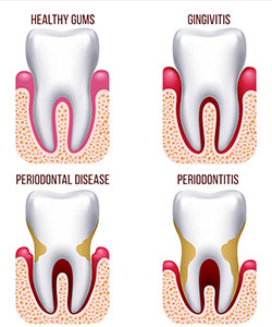 periodontitis infographic