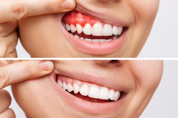 healthy gums vs gum disease