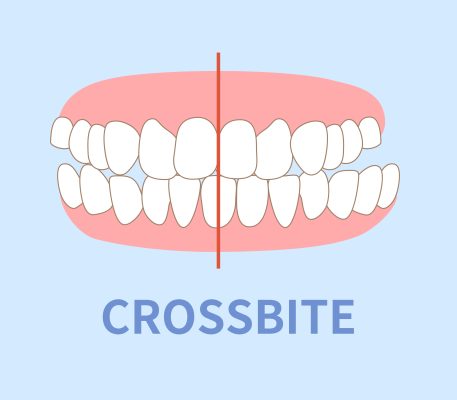 crossbite