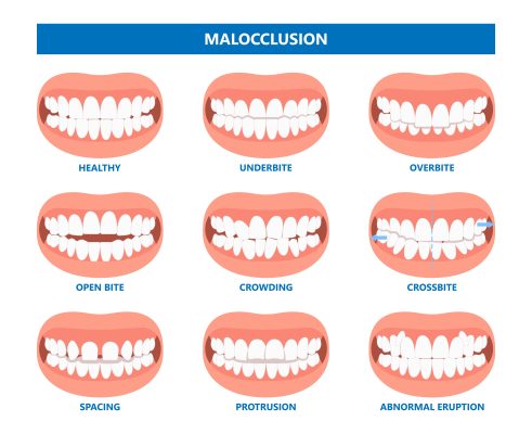 malocclusion chart